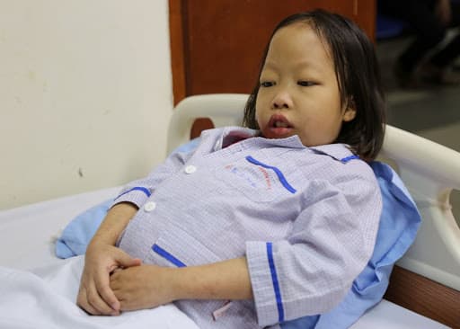 Biến dạng xương sống mũi và phù gan lách do thiếu máu bẩm sinh