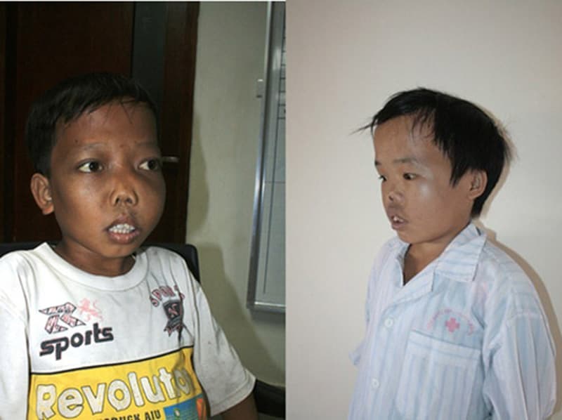 Trẻ bị thiếu máu bẩm sinh