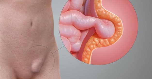 Thoát vị bẹn trái là gì và cách điều trị hiệu quả