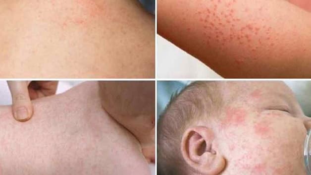 Khi trẻ bị sốt phát ban cơ thể sẽ nổi nhiều nốt nhỏ màu hồng, li ti, thường không gây ngứa ngáy