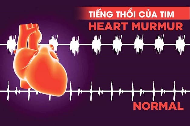 Tiếng thổi của tim là một triệu chứng thực thể của bệnh hẹp van tim