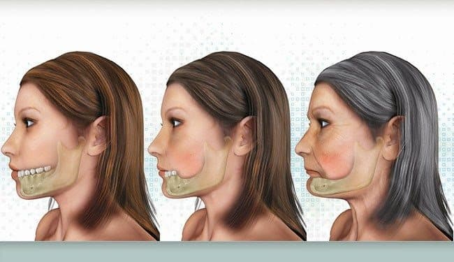 Biến dạng mặt do tiêu xương hàm