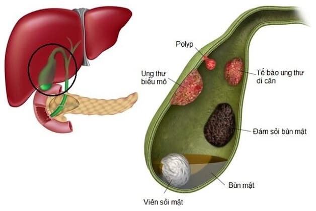 Túi mật có polyp có thể tiến tiển thành ung thư gây nguy hiểm đến tính mạng