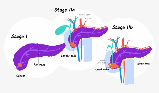 ung thư tụy giai đoạn 2