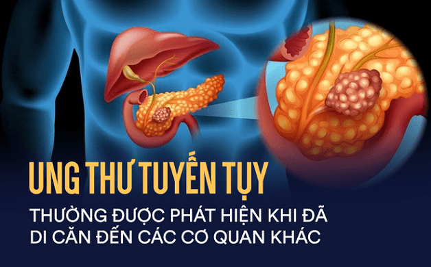 ung thư tụy là ung thư gì
