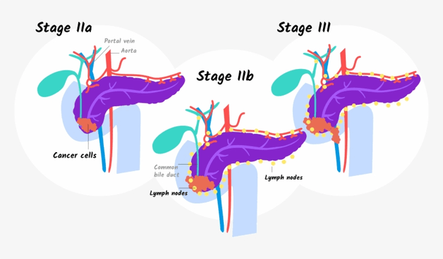 ung thư tuyến tụy giai đoạn 3