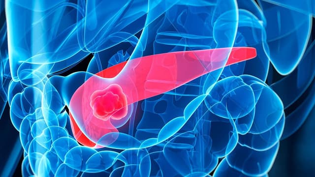 Ung thư tuyến tụy giai đoạn 4: Liệu có chữa được không?