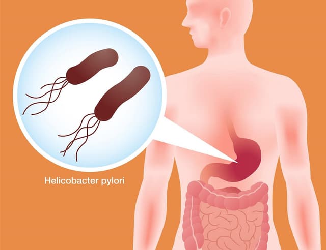 Vi khuẩn HP có lây không và cách phòng tránh hiệu quả