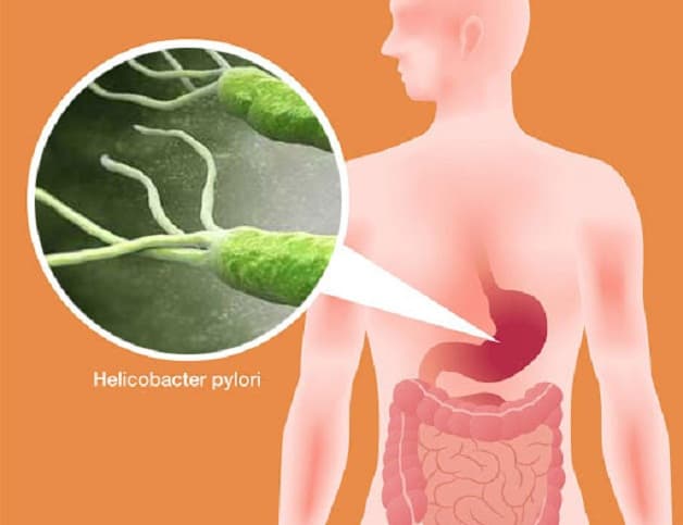 Vi khuẩn Hp có khả năng tồn tại và phát triển trong dạ dày
