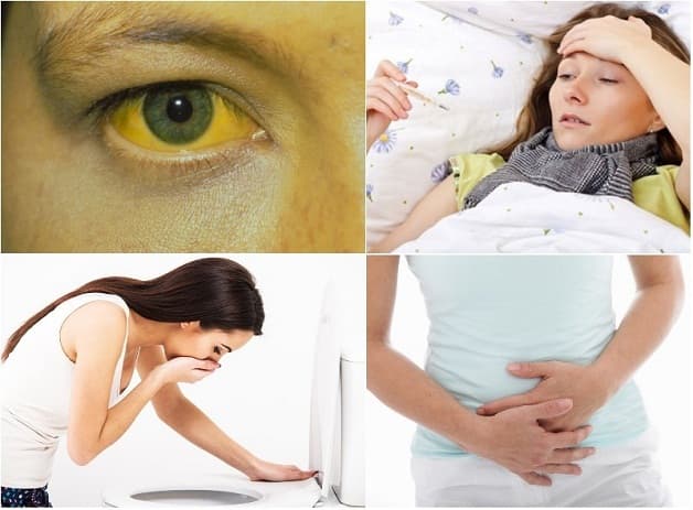 Đau hạ sườn phải, rối loạn tiêu hóa, vàng da vàng mắt là những biểu hiện của viêm túi mật bệnh học