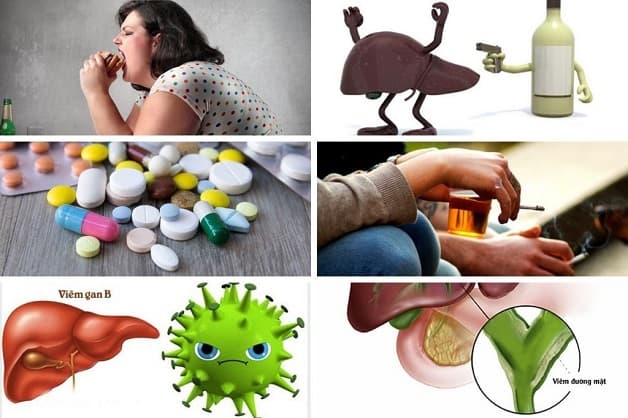 Xơ gan cổ trướng do rất nhiều các nguyên nhân gây ra.