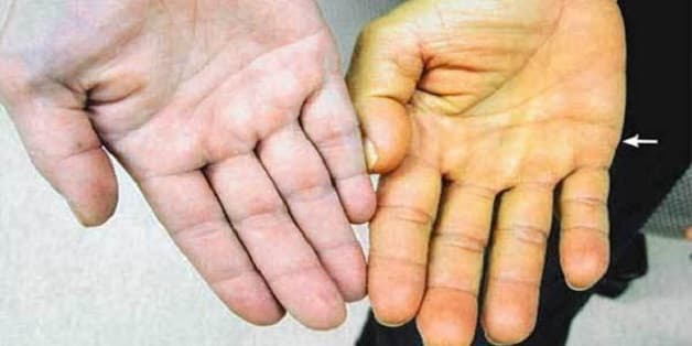 Vàng da là một trong những triệu chứng dễ nhận biết của bệnh xơ gan cổ trướng.