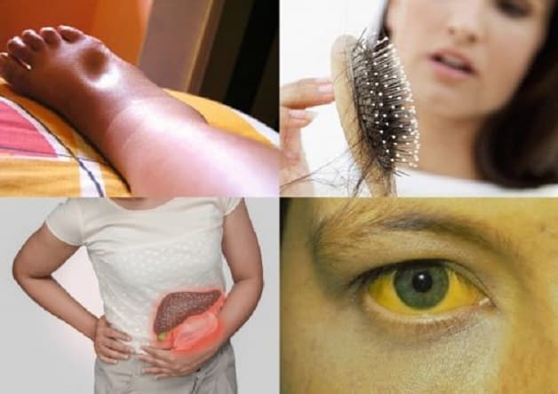 Các triệu chứng của bệnh xơ gan ở giai đoạn này đã rất rõ ràng.