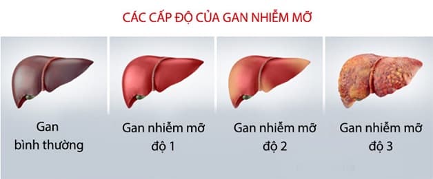 Các giai đoạn của bệnh gan nhiễm mỡ