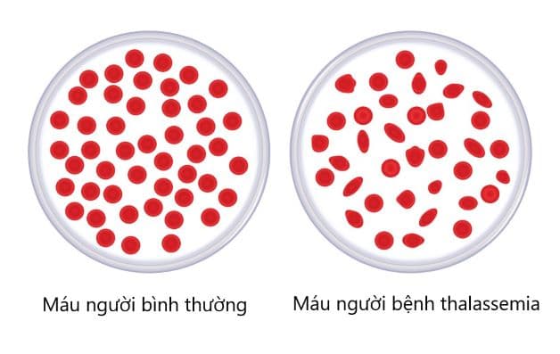 Thalassemia là một tình trạng thiếu máu huyết tán di truyền hoặc bẩm sinh với dấu hiệu điển hình là thiếu máu.