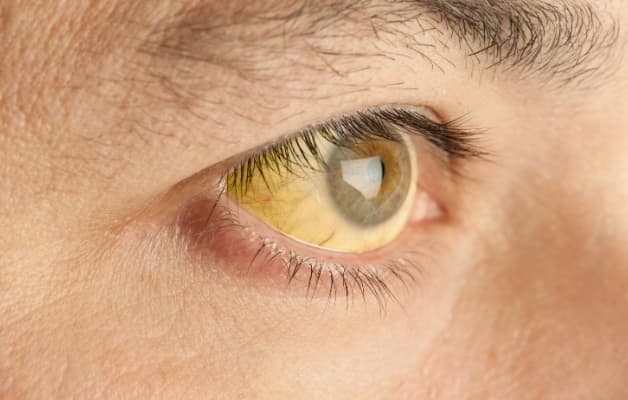 Bị viêm túi mật phải làm thế nào