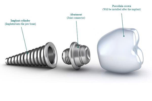 Cấu tạo implant gồm 3 phần: trụ implant, abutment và mão răng sứ