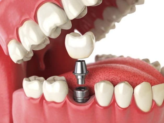 cấy ghép implant là phương pháp gì