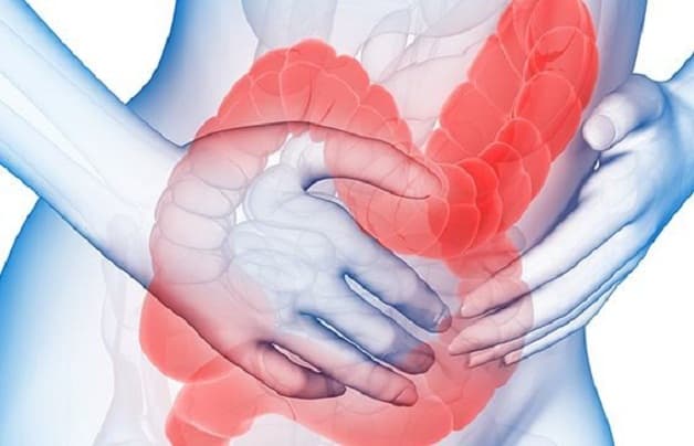 Đại tràng kích thích là gì?