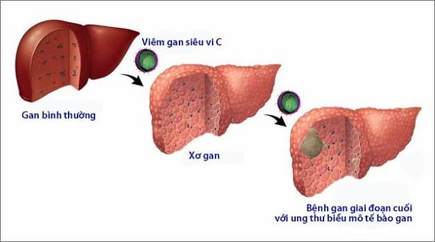 Bệnh viêm gan C phá hủy tế bào gan và dẫn đến ung thư gan