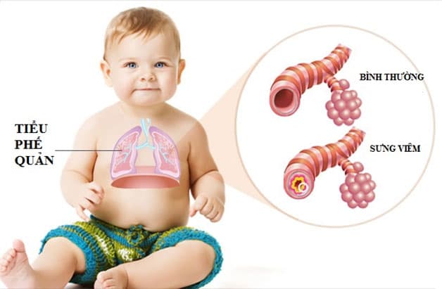 Viêm phế quản là bệnh nhiễm trùng các ống dẫn khí trong phổi.