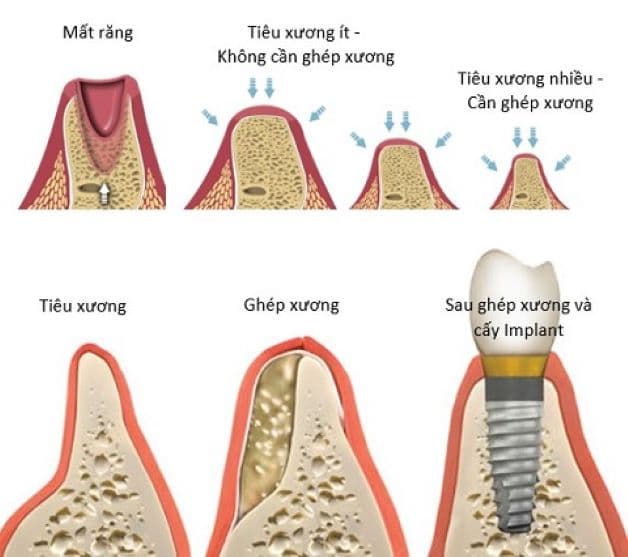 Những người bệnh gặp tình trạng tiêu xương, muốn trồng răng implant thì cần phải cấy ghép xương để đảm bảo tiêu chuẩn.