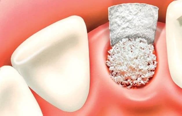 Kỹ thuật ghép xương trong quá trình trồng răng implant được xem là một phương pháp tiến bộ vượt bậc trong việc điều trị nha khoa.