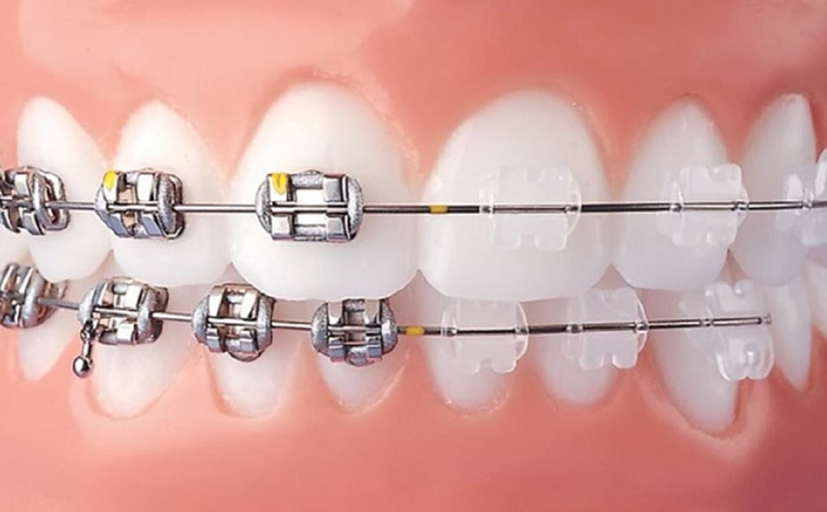 Góc giải đáp: nên niềng răng mắc cài sứ hay kim loại? 