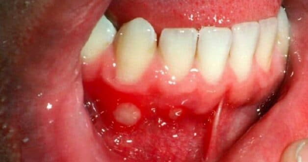 cách phòng ngừa nhiệt miệng ở nướu