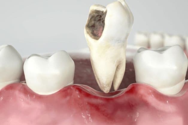 Niêm mạc miệng bị khô sẽ khiến vi khuẩn có điều kiện tấn công, gây nên các bệnh lý răng miệng.