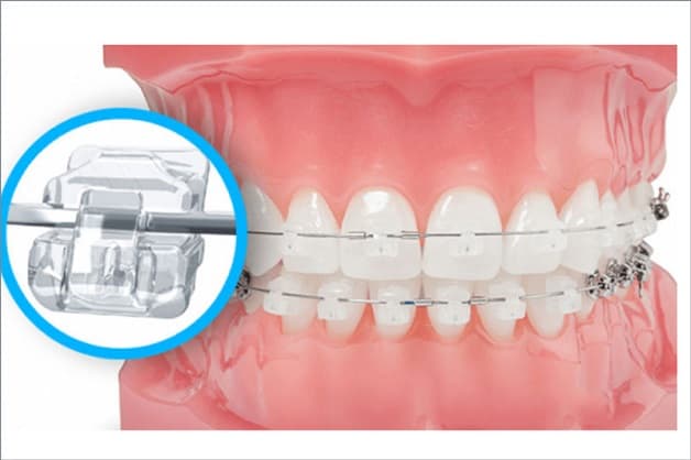 Chất liệu pha lê hay bị vỡ, mẻ, không cứng chắc như kim loại nên trong quá trình niềng để đảm bảo an toàn nên hạn chế việc ăn các đồ dai cứng hoặc va đập mạnh từ bên ngoài…