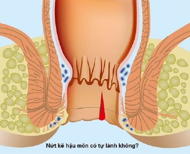 Nứt kẽ hậu môn tự lành được không?