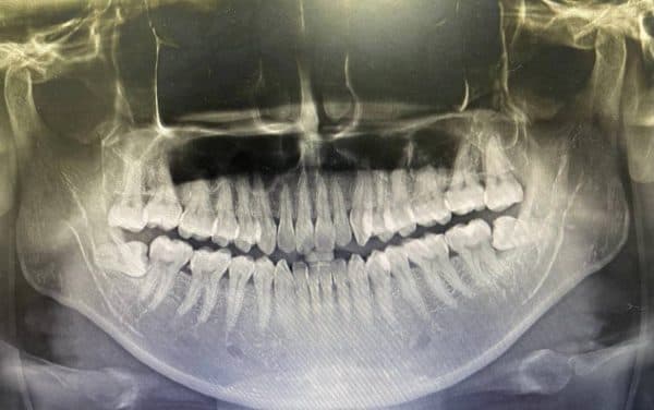 Hình ảnh chụp X-quang răng khôn mọc lệch và đâm vào thân răng số 7 bên cạnh