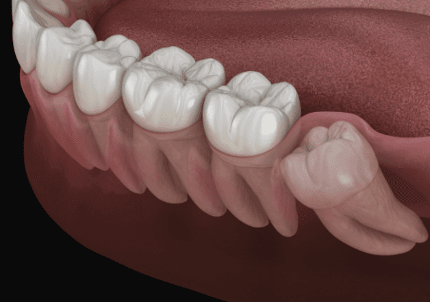 Nếu không điều trị kịp thời, răng khôn có thể gây ra nhiều ảnh hưởng cho người bệnh