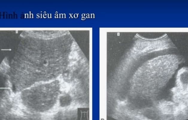 Hình ảnh gan xơ trên siêu âm