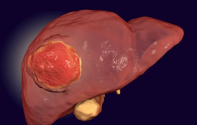 Xơ gan gây ra nhiều biến chứng nguy hiểm
