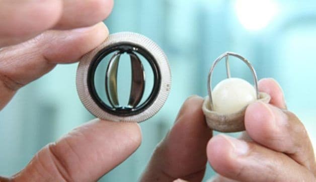 Thay van tim là phương pháp điều trị cuối cùng trong những trường hợp hẹp van hai lá quá nặng, không thể điều trị bằng các phương pháp khác