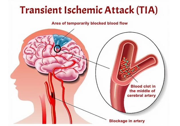 Thiếu máu não cục bộ thoáng qua