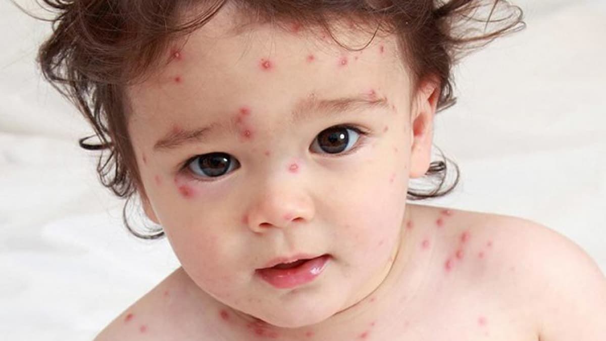 Trẻ bị thủy đậu