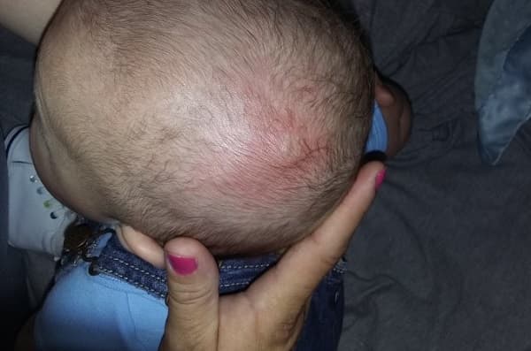 Mụn đinh trên đầu trẻ