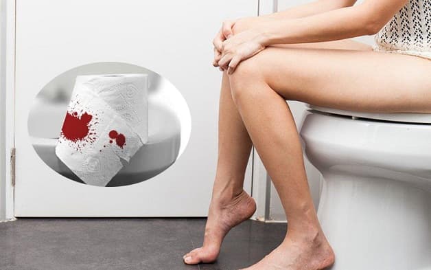 Viêm đại tràng xuất huyết gây đi ngoài phân máu 