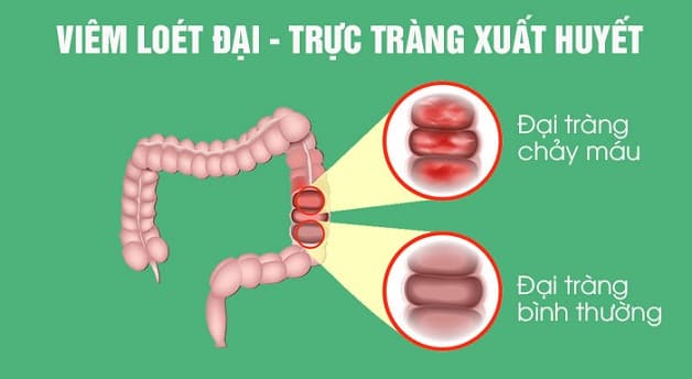 Viêm đại tràng xuất huyết là tình trạng tổn thương gây chảy máu nhiều lần ở đại tràng 