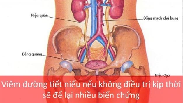 Giải đáp viêm đường tiết niệu khám ở khoa nào?