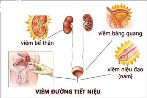Viêm đường tiết niệu khám ở khoa nào là thắc mắc của nhiều người bệnh. 