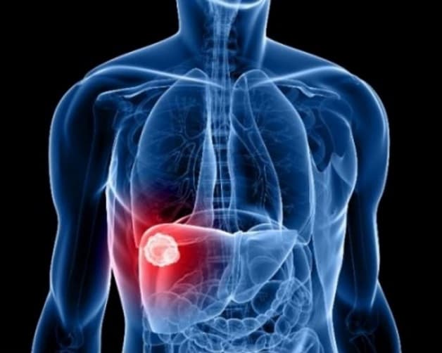 Viêm gan B mãn tính có nhiều triệu chứng điển hình