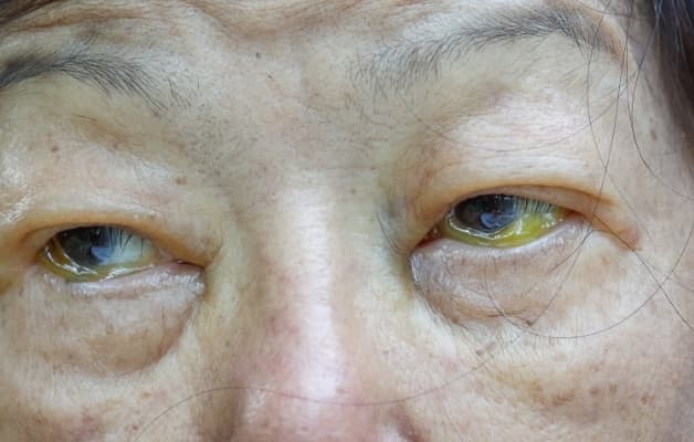 Mắt vàng là một trong những biểu hiện điển hình của viêm gan