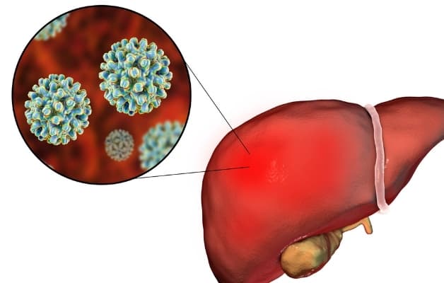 Viêm gan cấp tính gây ra do tác nhân virus