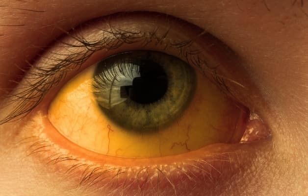 Vàng mắt - Dấu hiệu đặc trưng của viêm gan