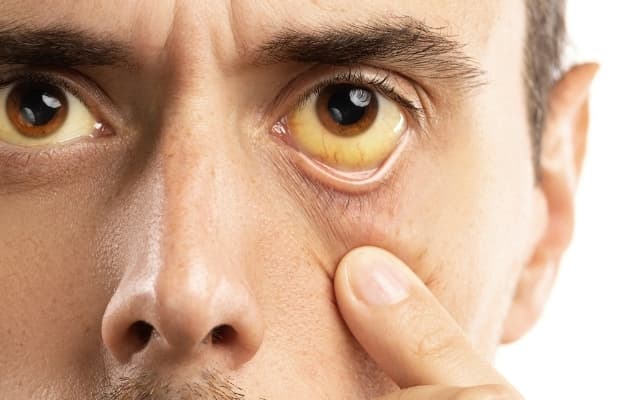 Vàng da và vàng kết mạc mắt