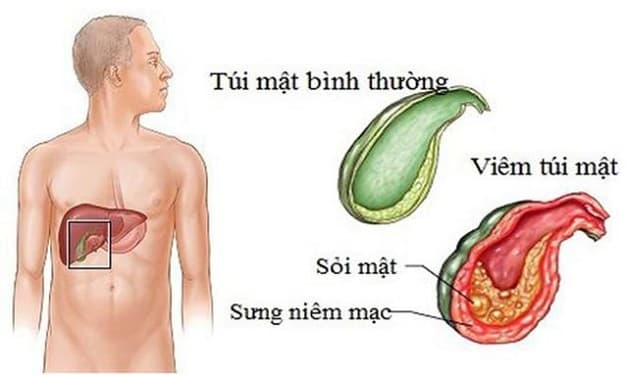 Phân biệt hình ảnh của túi mật bình thường và túi mật bị viêm